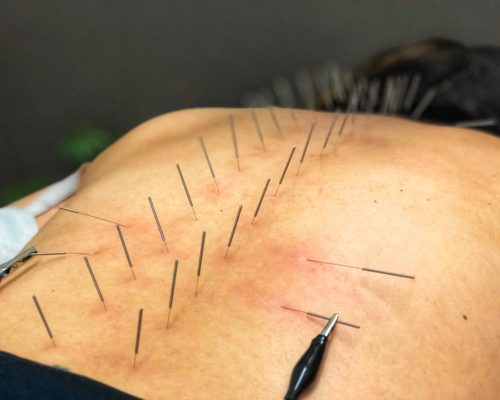 West Palm Beach Acupuncture Treatment